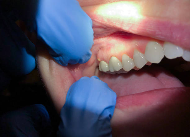 Best Emergency Dental Care for Sports Injuries in Canton, MO